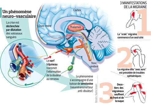 Migraine la recherche explose